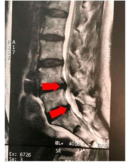 Lumbar spine MRI showing disc dehydration with protrusion at L4-L5-S1