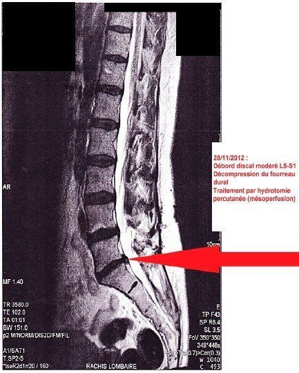 Lumbar spine MRI after treatment showing a moderate L5-S1 disc protrusion with decompression of the dural sac
