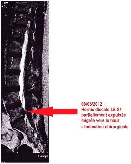 Lumbar spine MRI before treatment showing a partially extruded L5-S1 disc herniation