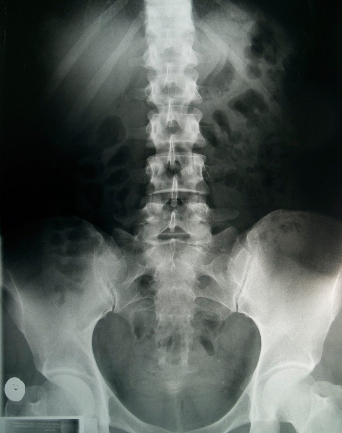 Beckenröntgenbild zur Beurteilung von Arthrose